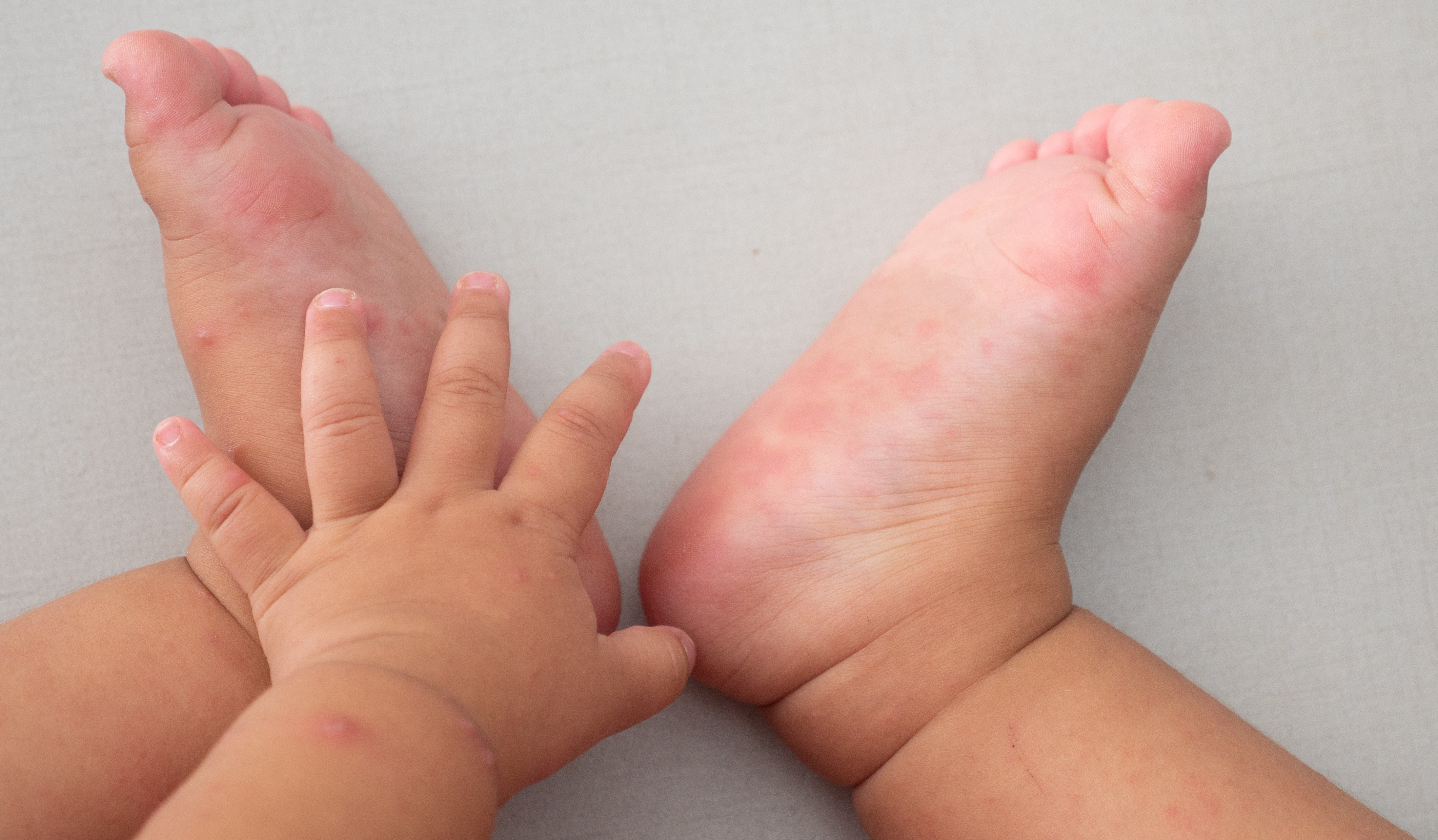 hand-foot-and-mouth-disease-viral-infection-2-testimonials-a